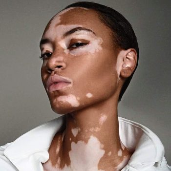 cover-girl-features-first-vitiligo-model-in-ad-campaign