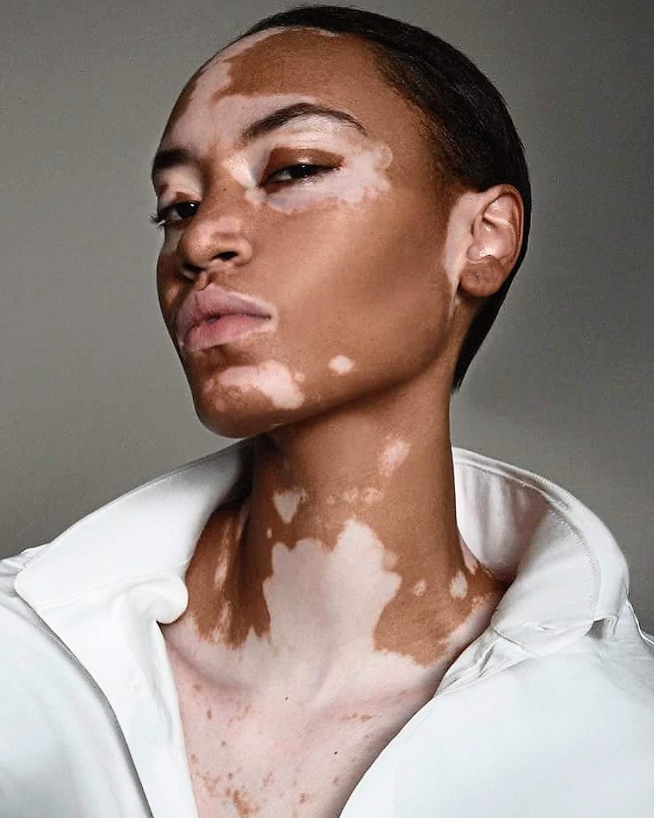 cover-girl-features-first-vitiligo-model-in-ad-campaign