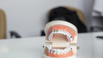 braces-vs-aligners-which-one-is-better