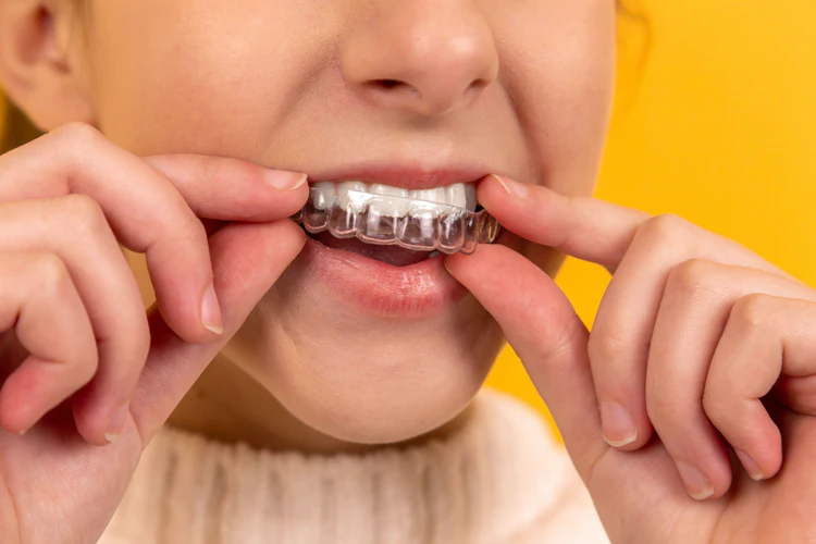 Braces Vs Aligners: Which One Is Better?