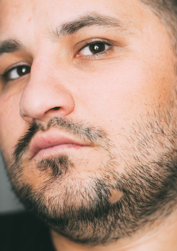 The Cost Factor: Is A Beard Transplant Worth The Investment? 